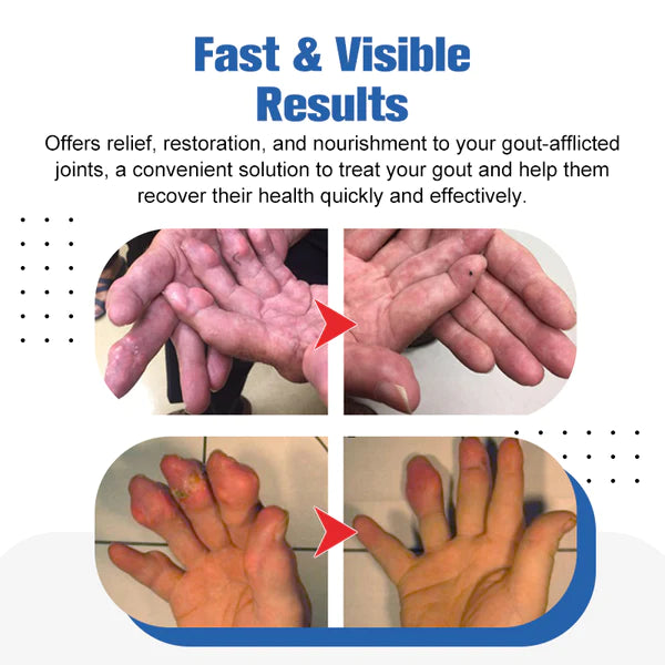 PyretoXcel™ Gout Treatment Snake Venom Potent Ointment