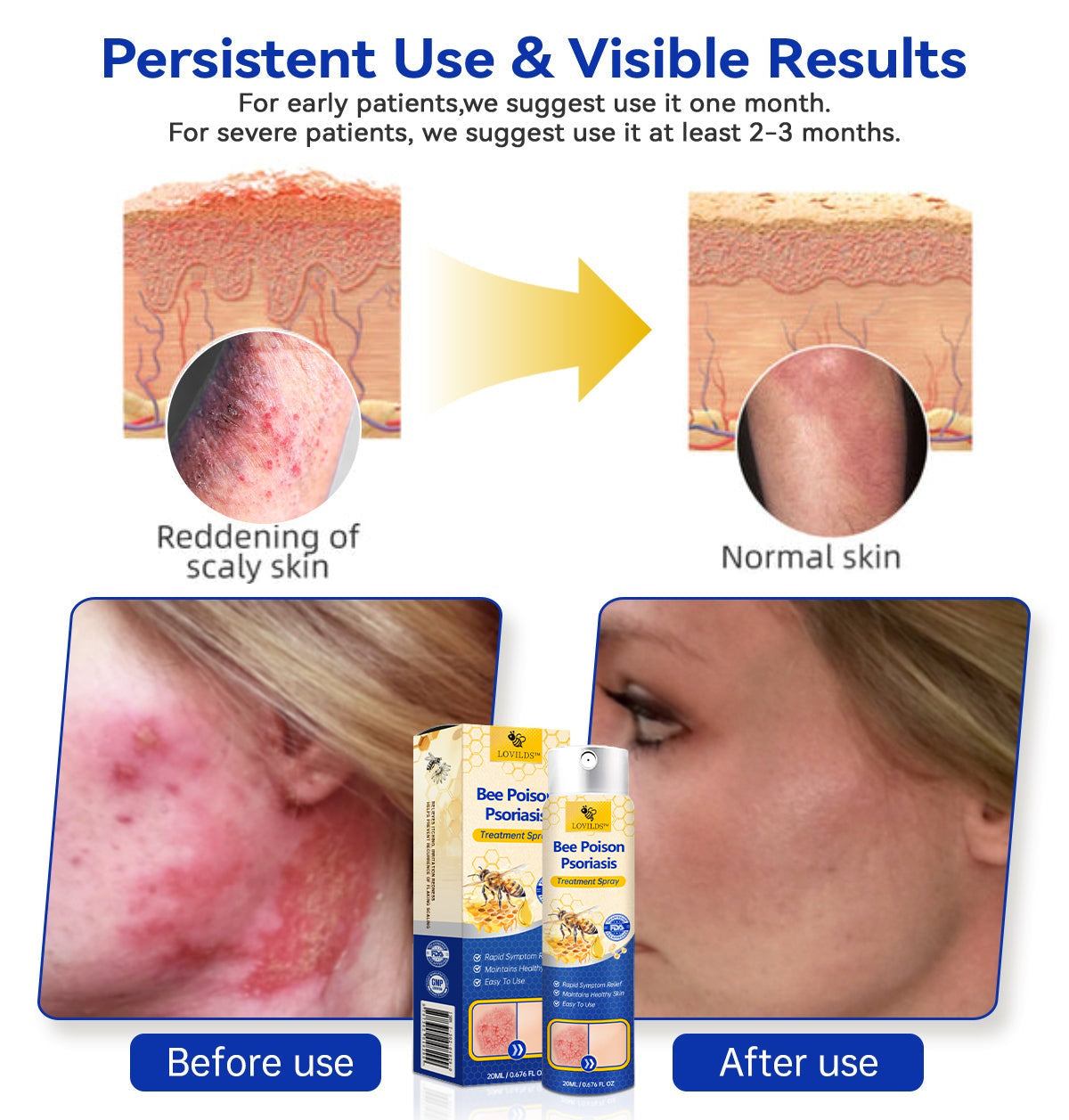 LOVILDS™ PsoriaHeal Bee Venom Psoriasis Treatment Spray pro