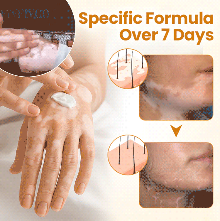 【🎌From japan🎌】Bee Venom Vitiligo Herbal Body Cream🔥LAST DAY Promotion 48% OFF🔥