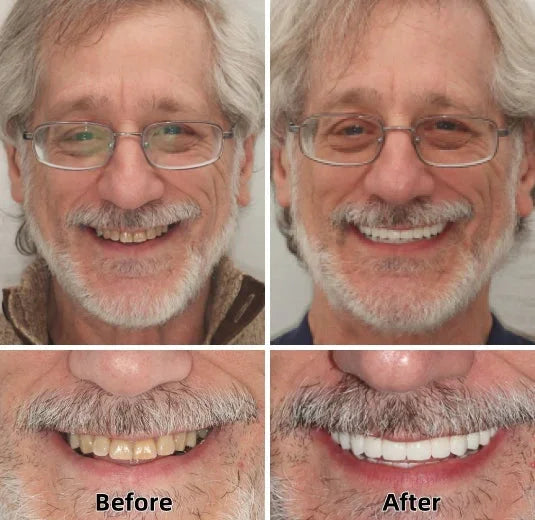 🦷💝LAOZIK™-Advanced Custom-Fit Functional Dentures👨⚕😁