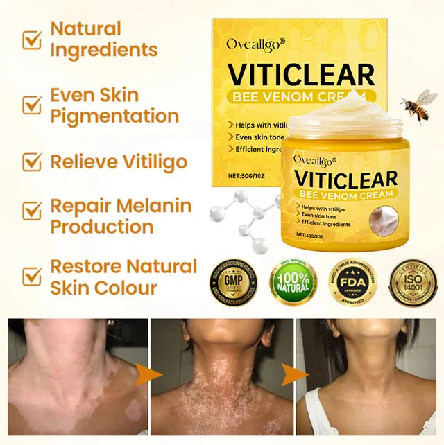 【🎌From japan🎌】Bee Venom Vitiligo Herbal Body Cream🔥LAST DAY Promotion 48% OFF🔥