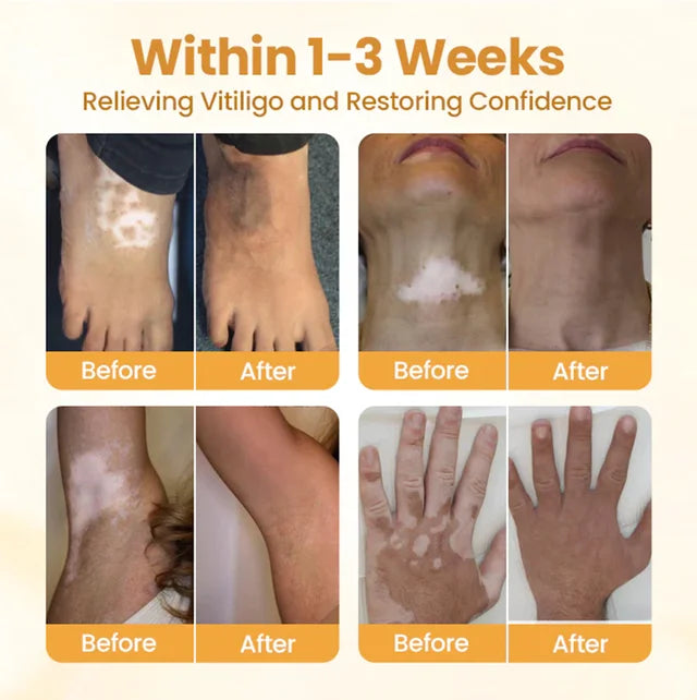 【🎌From japan🎌】Bee Venom Vitiligo Herbal Body Cream🔥LAST DAY Promotion 48% OFF🔥