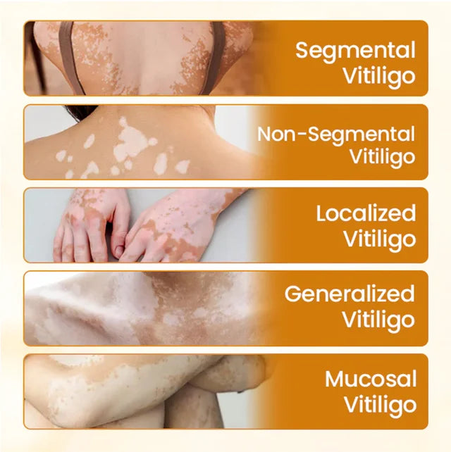 【🎌From japan🎌】Bee Venom Vitiligo Herbal Body Cream🔥LAST DAY Promotion 48% OFF🔥