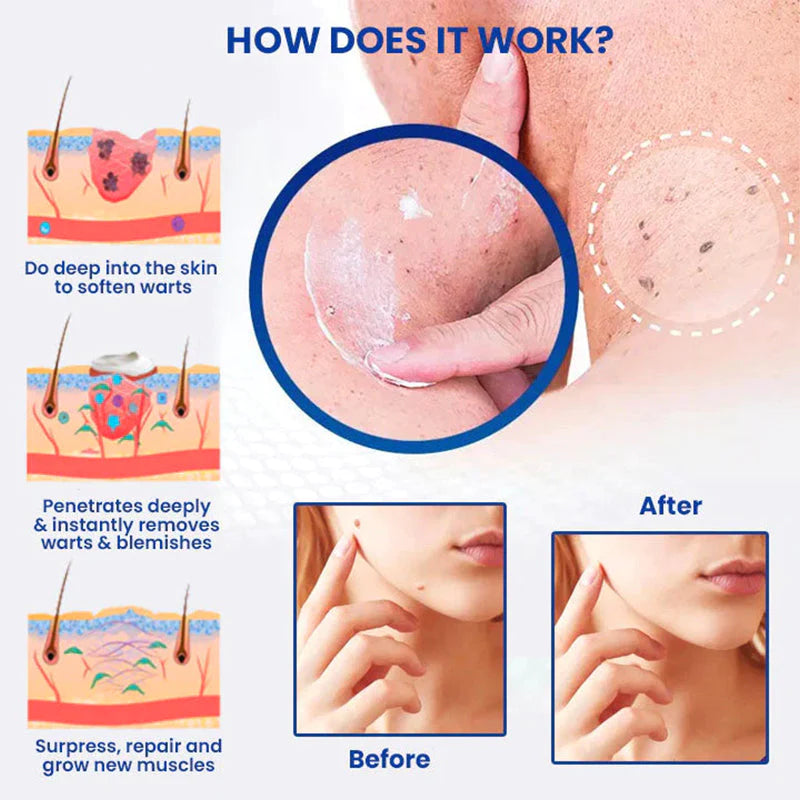 DermaEnd™ Wart Remover Herbal Ointment 100% Natural