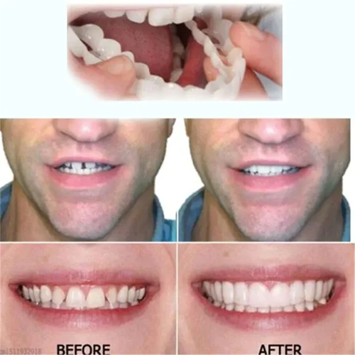 Sxcpouw™ Adjustable Snap-On Dentures🔥HOT SALE 48%🔥