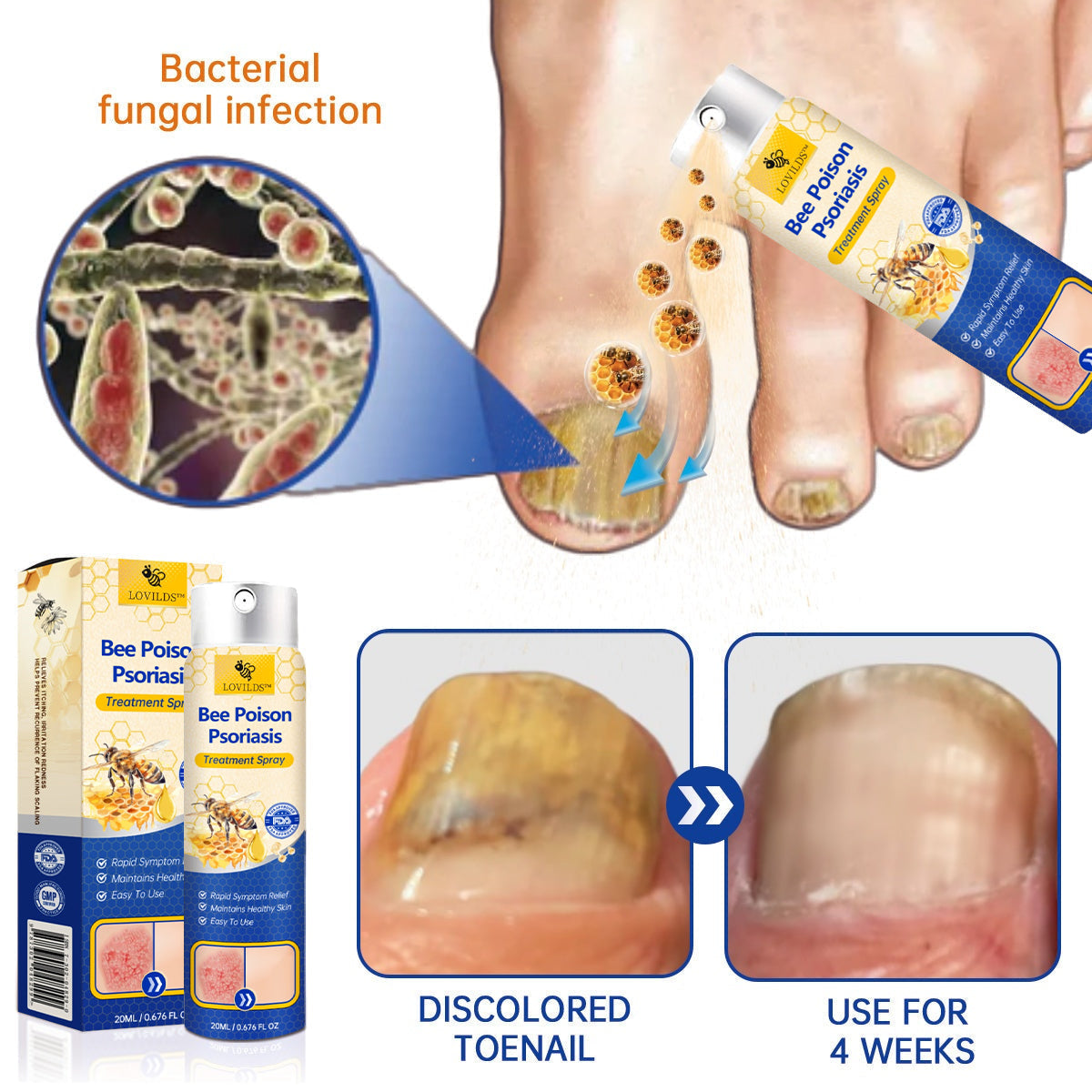 LOVILDS™ PsoriaHeal Bee Venom Psoriasis Treatment Spray pro