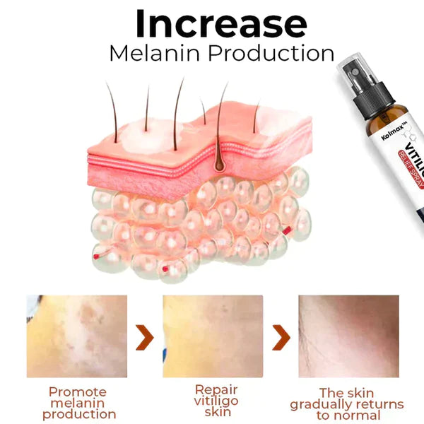 Kolmax™ VitiligoX Relief Spray (Limited Time Discount 50% OFF🔥 Last Day)