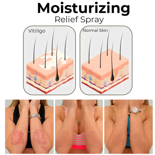 Kolmax™ VitiligoX Relief Spray (Limited Time Discount 50% OFF🔥 Last Day)