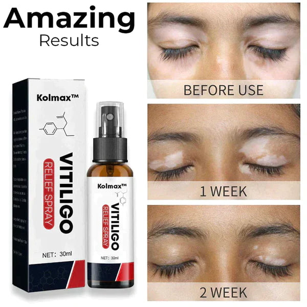 Kolmax™ VitiligoX Relief Spray (Limited Time Discount 50% OFF🔥 Last Day)