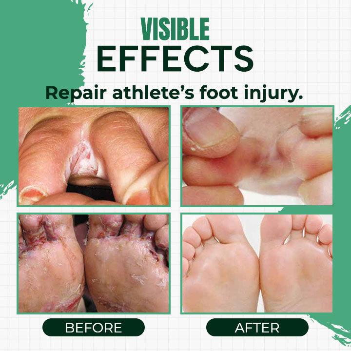 Hand Ringworm Beriberi Fungus Spray
