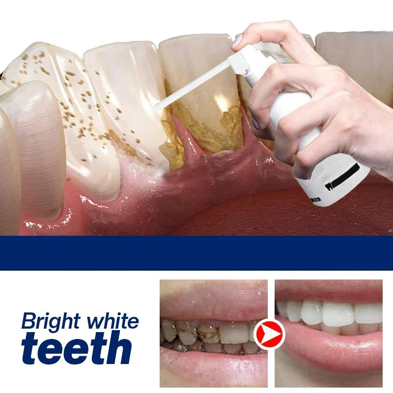 Calculus Free Dissolving Dental Spray【COD + Local Stock !】