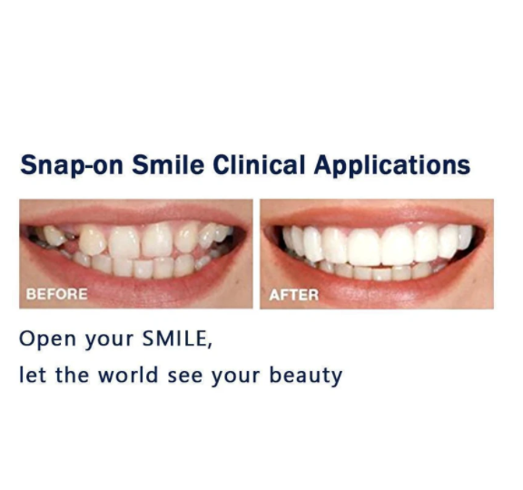 Magic Smile Teeth Brace 【Can eatting】100% non-inductive fit, no foreign body sensation!😁 (💥45% OFF) - 🔥HOT SALE🔥🎉