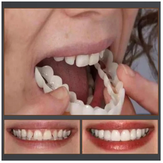 Magic Smile Teeth Brace 【Can eatting】100% non-inductive fit, no foreign body sensation!😁 (💥45% OFF) - 🔥HOT SALE🔥🎉