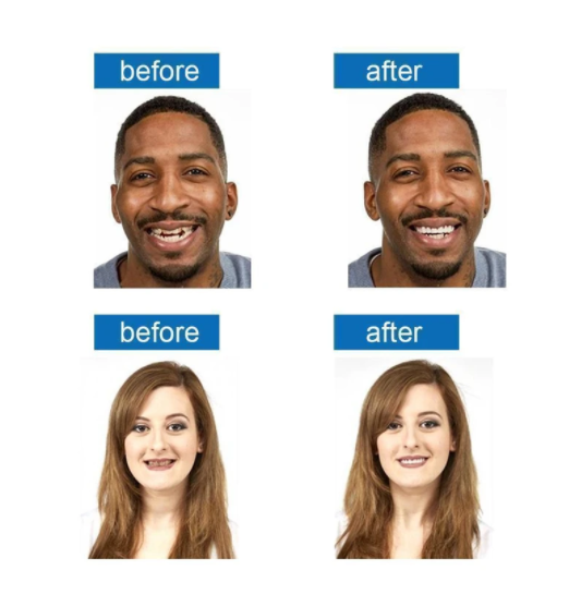 Magic Smile Teeth Brace 【Can eatting】100% non-inductive fit, no foreign body sensation!😁 (💥45% OFF) - 🔥HOT SALE🔥🎉