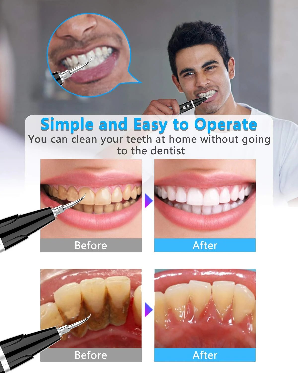 👨⚕🦷Electric tooth cleaning instrument -Teeth Cleaner