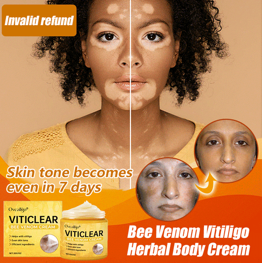 【🎌From japan🎌】Bee Venom Vitiligo Herbal Body Cream🔥LAST DAY Promotion 48% OFF🔥