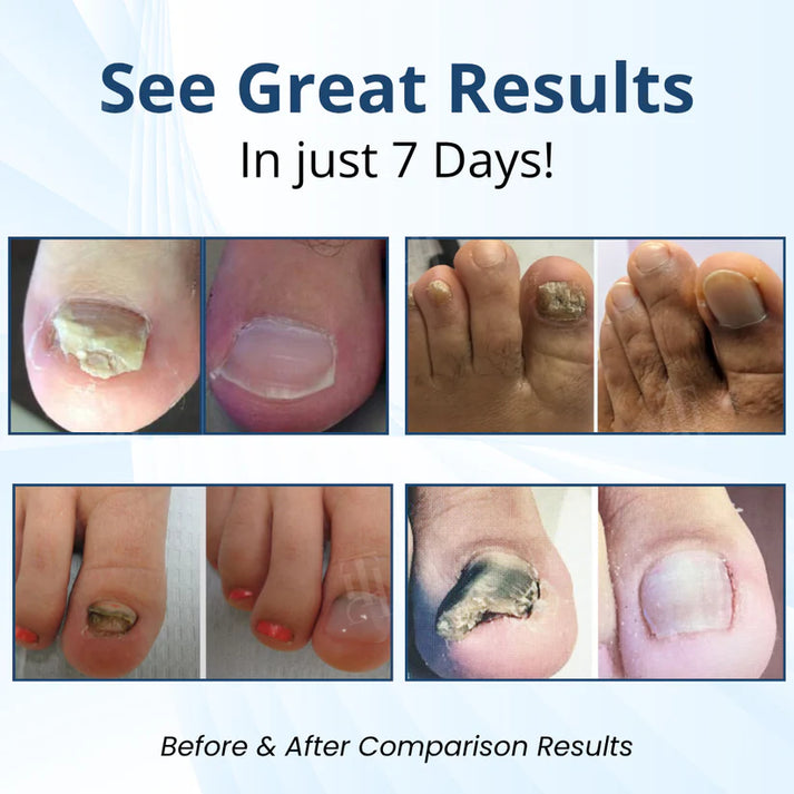 ⭐🎉Countdown to 2026: 60% OFF⭐🎉MycoShield Pro Fungal Nail Patches