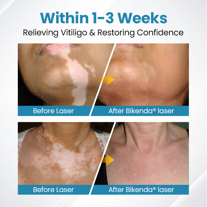 💥Bikenda® DermaBeam Vitiligo Therapy Device⏳Limited-time 48% off⏰💥