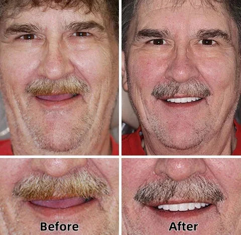 🦷💝LAOZIK™-Advanced Custom-Fit Functional Dentures👨‍⚕😁