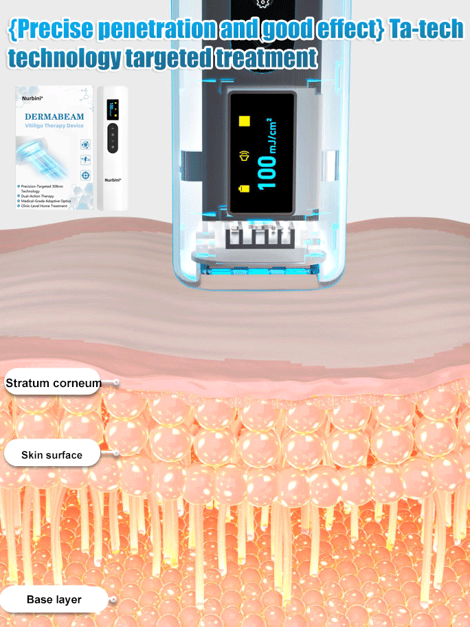 Nurbini® DermaBeam Vitiligo Therapy Device⏳Limited-time 49% off⏰💥