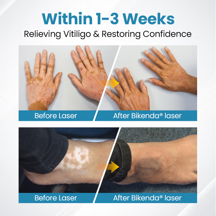 💥Bikenda® DermaBeam Vitiligo Therapy Device⏳Limited-time 48% off⏰💥