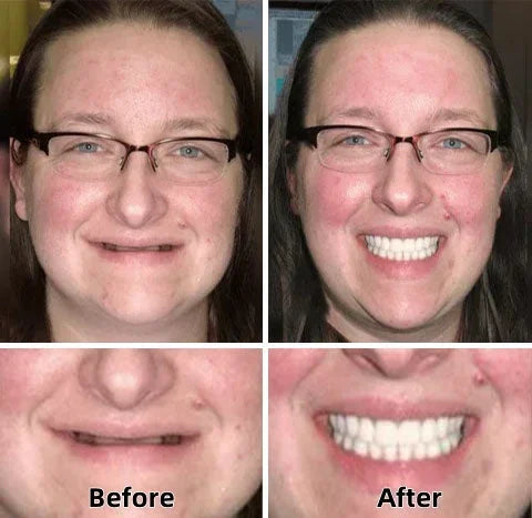 🦷💝LAOZIK™-Advanced Custom-Fit Functional Dentures👨‍⚕😁