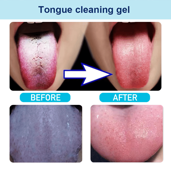 🔥2024 HOT Sale -Probiotic Tongue Cleaning Gel Set