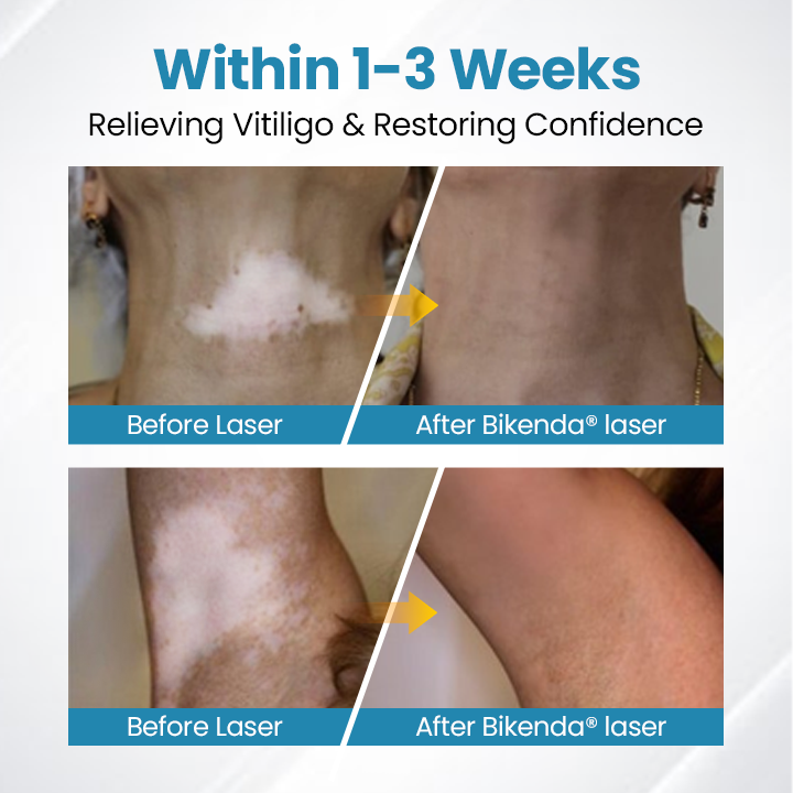 💥Bikenda® DermaBeam Vitiligo Therapy Device⏳Limited-time 48% off⏰💥