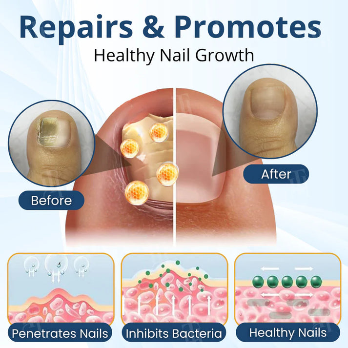 ⭐🎉Countdown to 2026: 60% OFF⭐🎉MycoShield Pro Fungal Nail Patches
