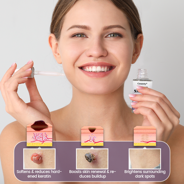 🔥Ceoerty® WartSmooth Renewal Serum🔥The FDA-Approved Solution🌟 Official Store