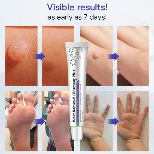 SkinRx™ Wart Removal Ointment Plus
