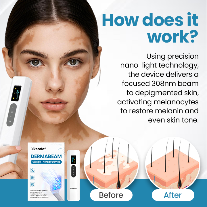 💥Bikenda® DermaBeam Vitiligo Therapy Device⏳Limited-time 48% off⏰💥