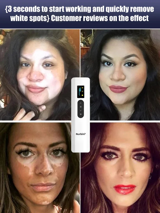 Nurbini® DermaBeam Vitiligo Therapy Device⏳Limited-time 49% off⏰💥