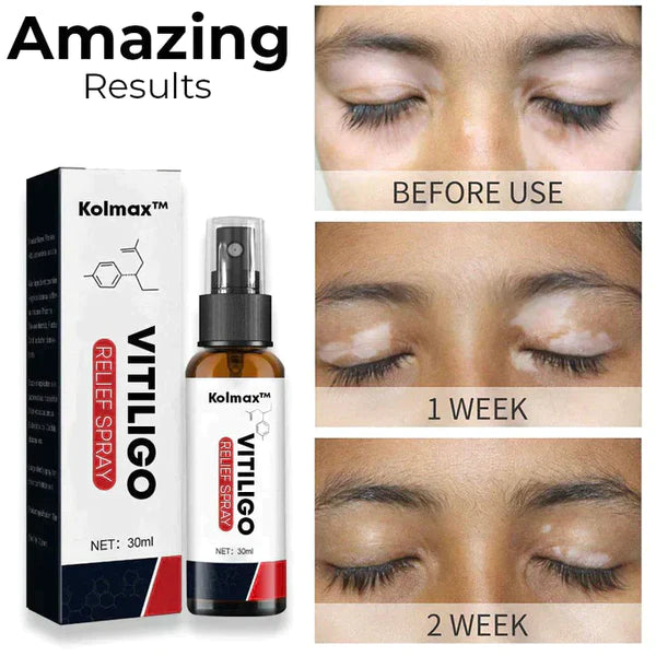 Kolmax™ VitiligoX Relief Spray (Limited Time Discount 50% OFF🔥 Last Day）