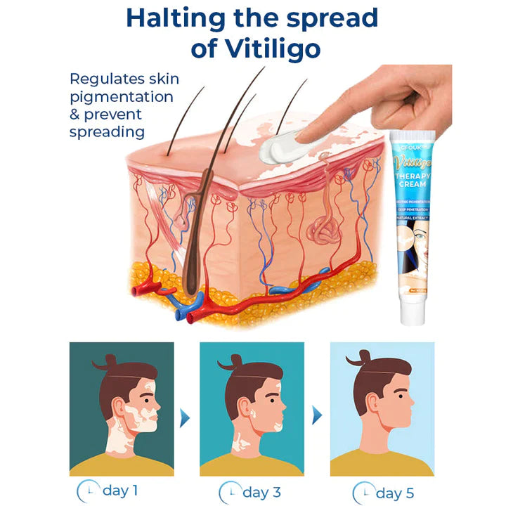 GFOUK™ Vitiligo Therapy Cream 的副本