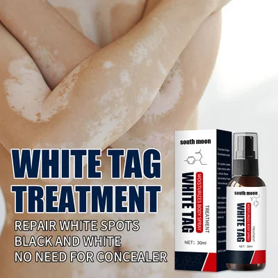 Tinea Versicolor White Spot Vitiligo Clean Spray