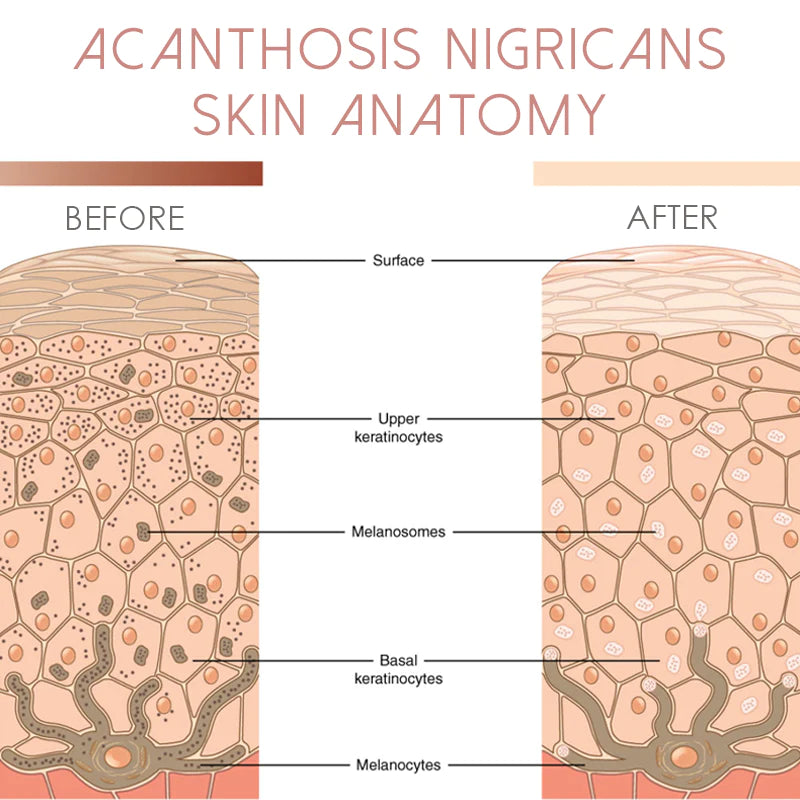 ATTDX Lightens AcanthosisNigricans TherapyOil