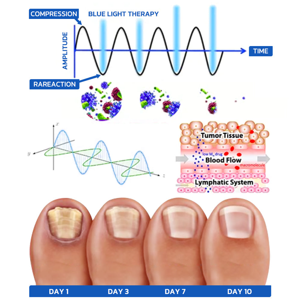 GFOUK™ FungusOFF Nail Laser Treatment Device