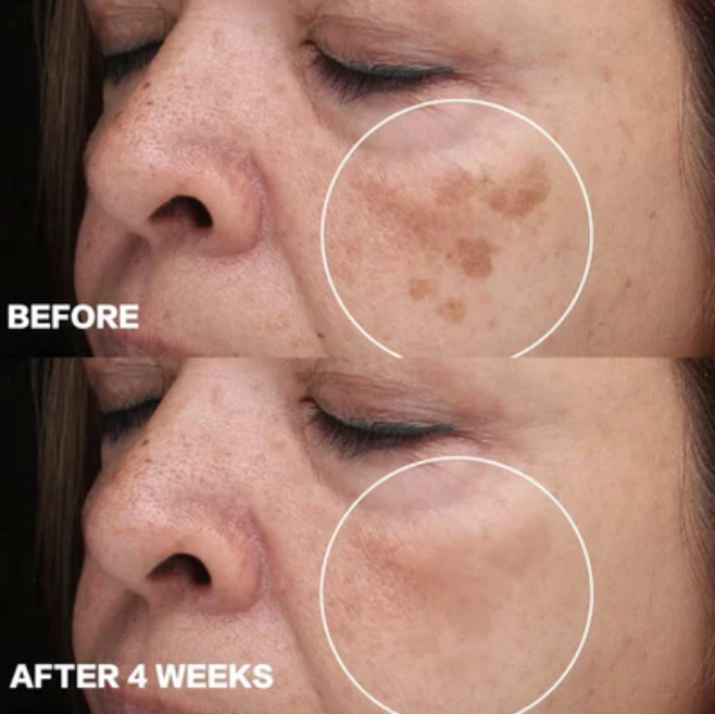 Organic Skin Spot Pigmentation Remover