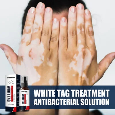 Tinea Versicolor White Spot Vitiligo Clean Spray